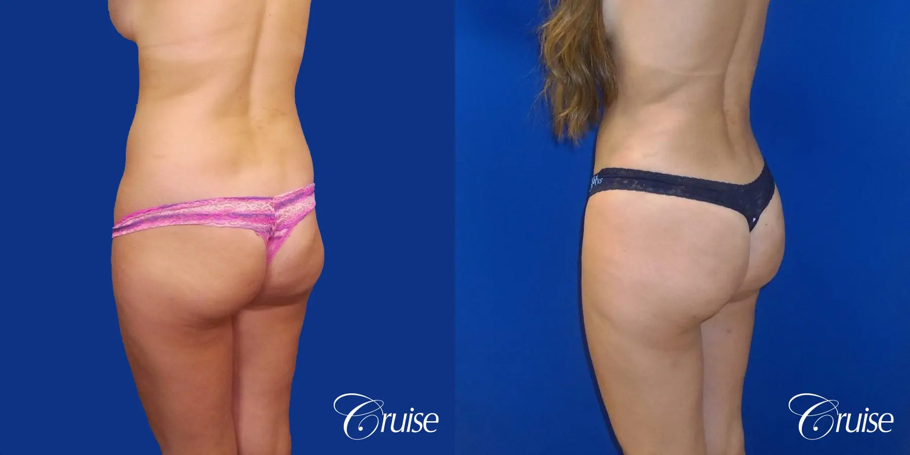 Liposuction - Before and After 5