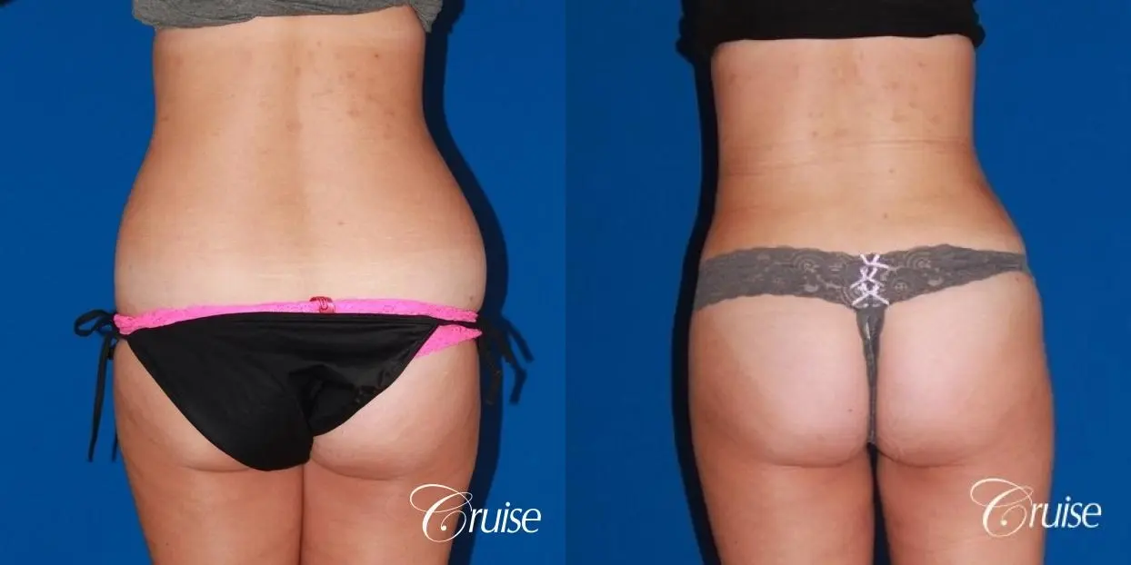 liposuction love handles and tummy - Before and After 4