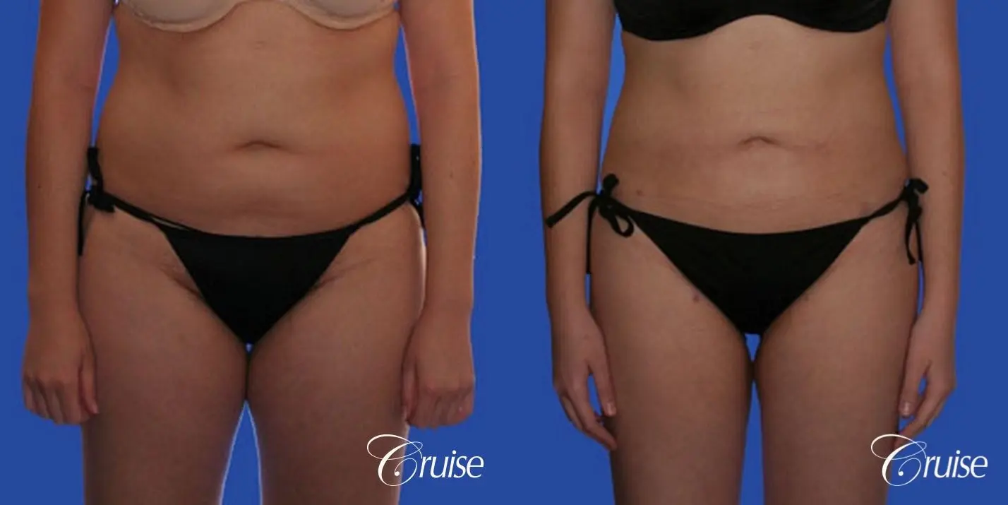 best pictures of liposuction with plastic surgeon in Newport Beach - Before and After 3