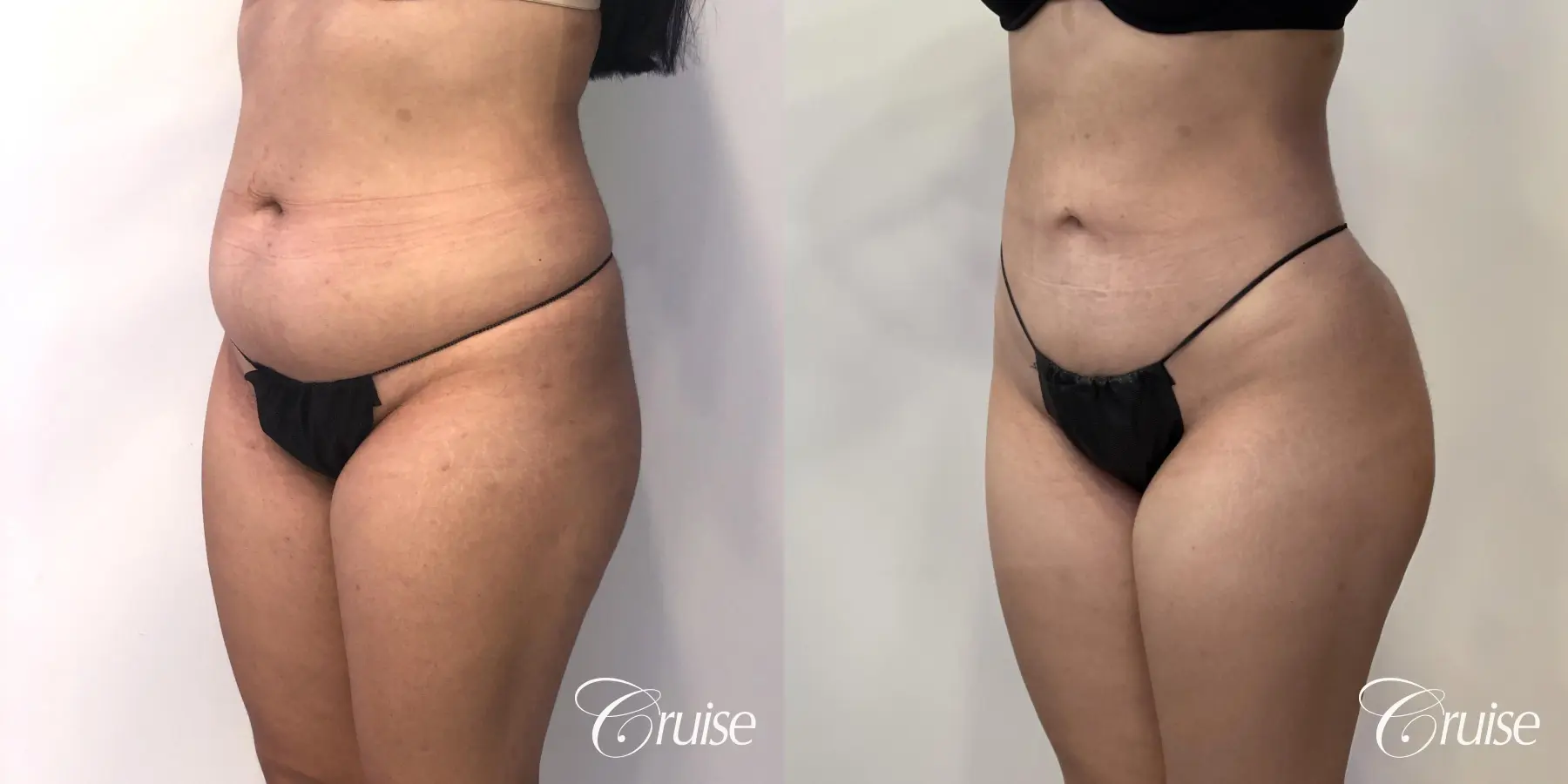 Liposuction: Patient 54 - Before and After 2