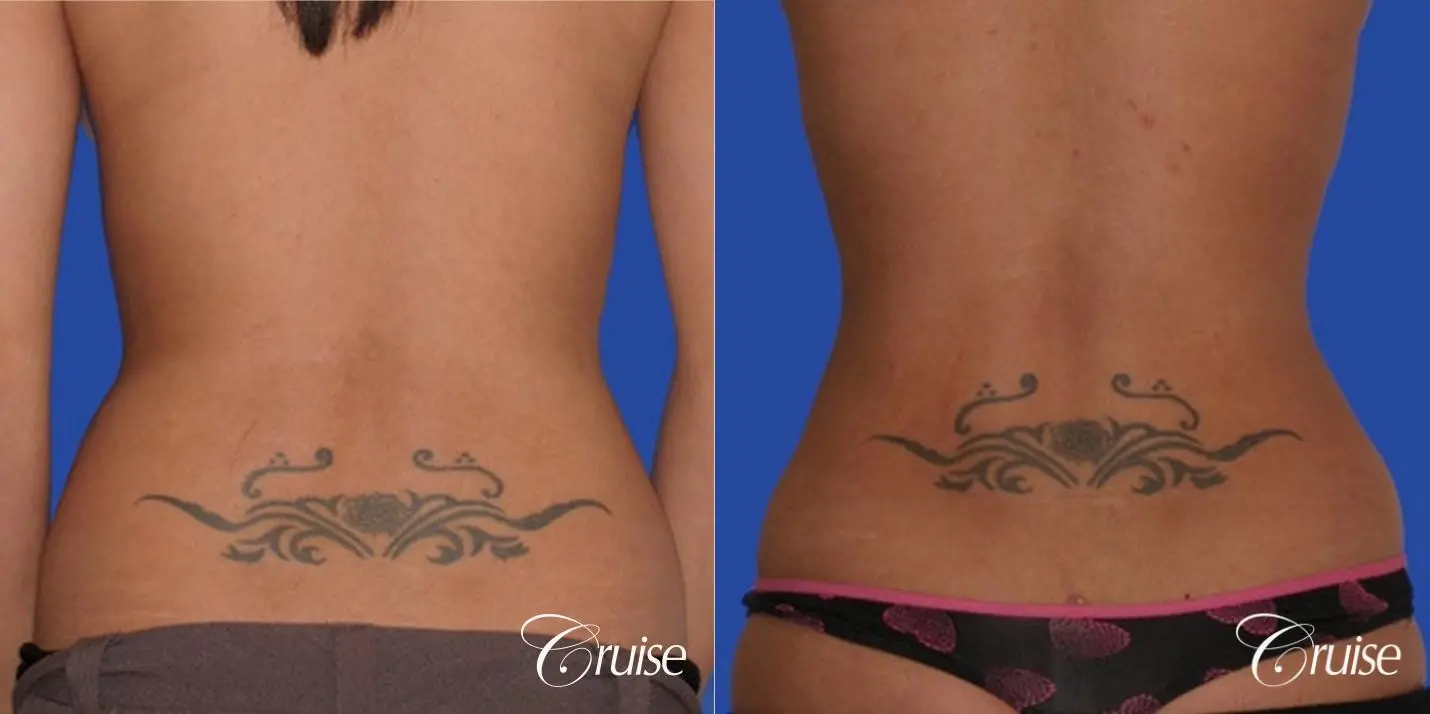 top plastic surgeon for liposuction in Newport Beach - Before and After 3
