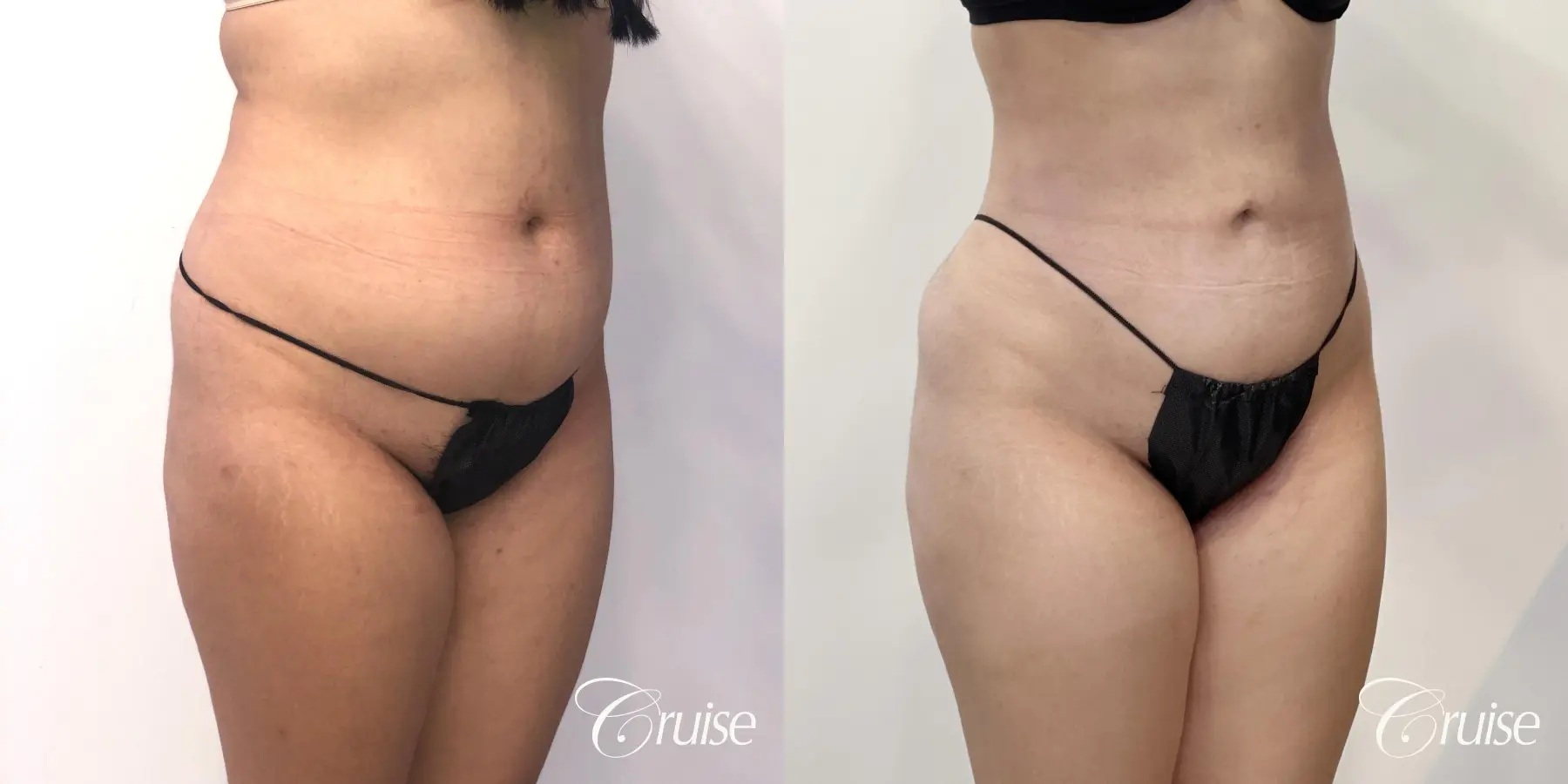 Liposuction: Patient 54 - Before and After 4