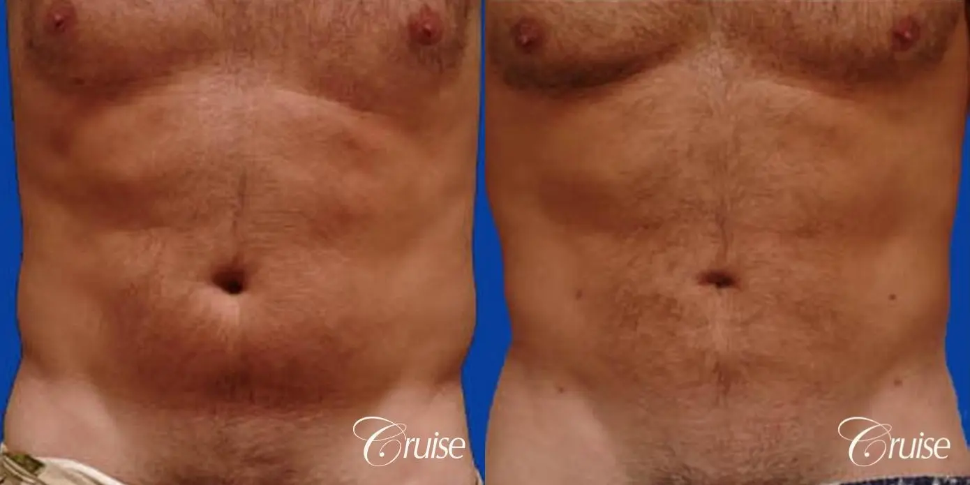 best male ab sculpting liposuction abdomen flanks - Before and After 1