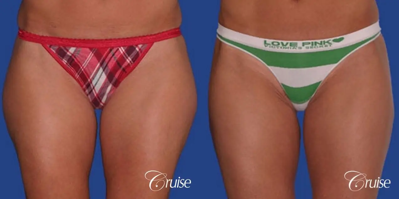 best thigh thinning liposuction on thighs - Before and After 2