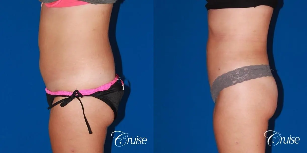 liposuction love handles and tummy - Before and After 3