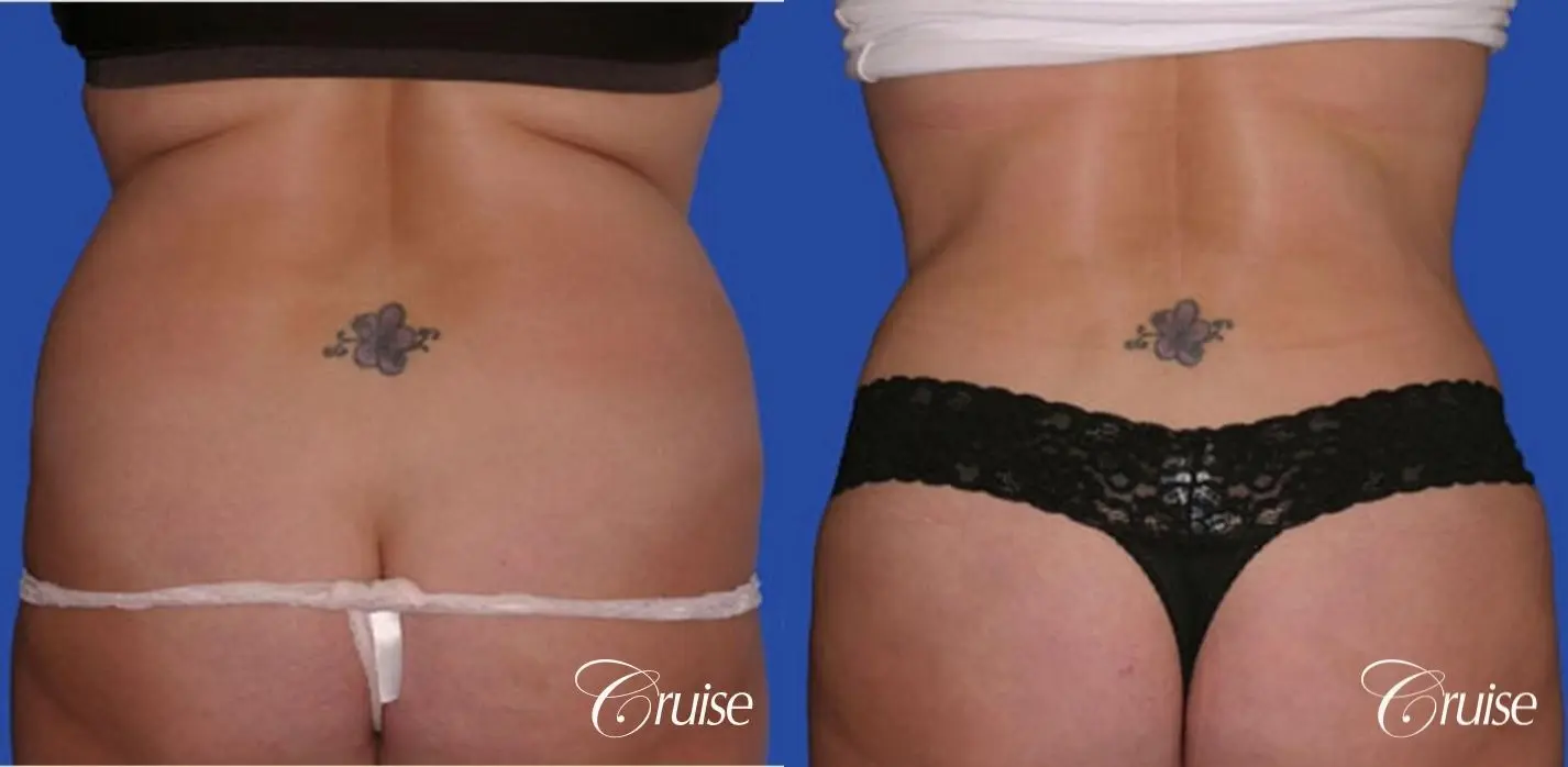 best dramatic flank liposuction pictures - Before and After 3