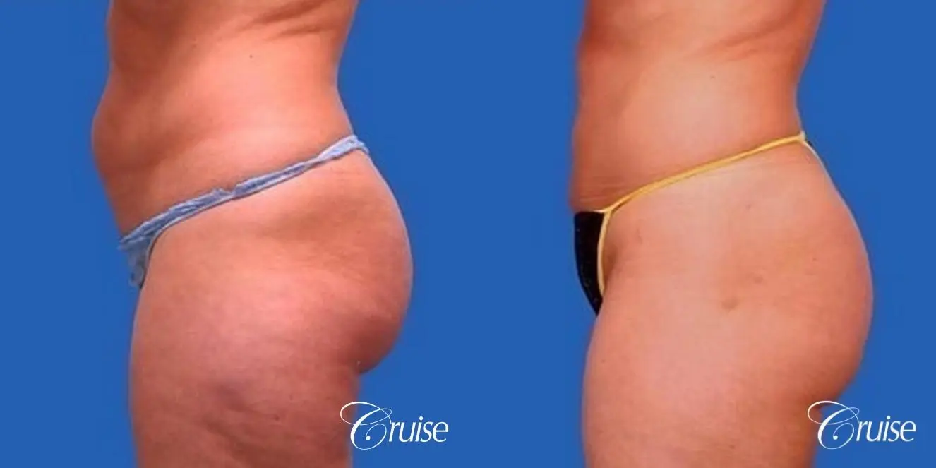 best liposuction abdomen, flanks and thighs - Before and After 2