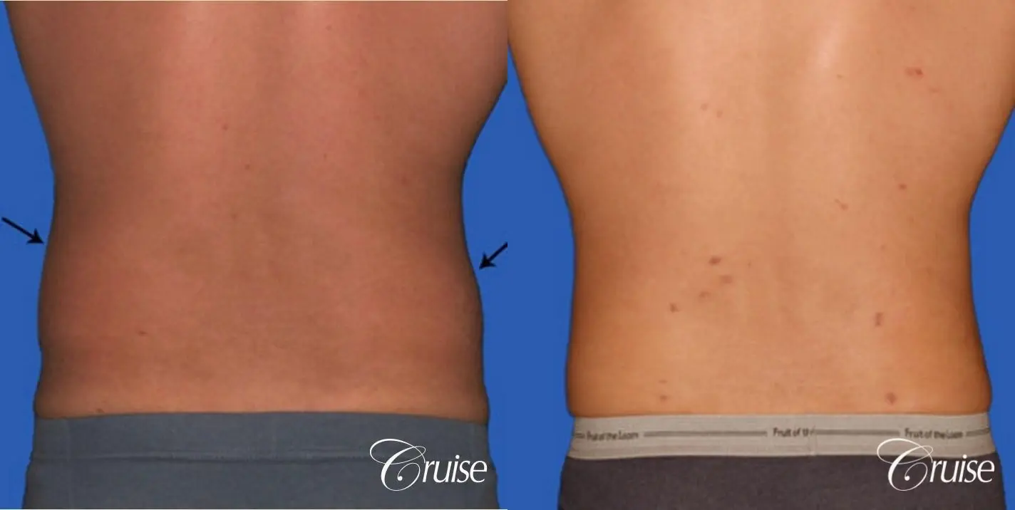 best liposuction to contour a males body - Before and After 3