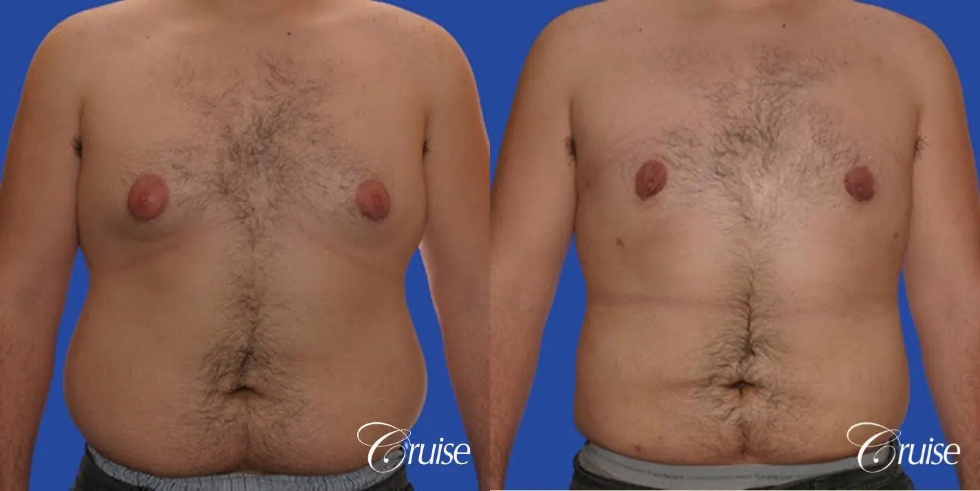male liposuction abdomen flanks with Gynecomastia - Before and After 1