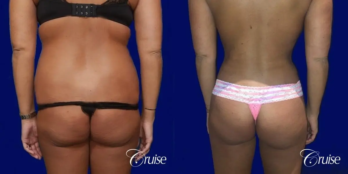 Liposuction Abdomen and Flanks with Midline Contour - Before and After 4