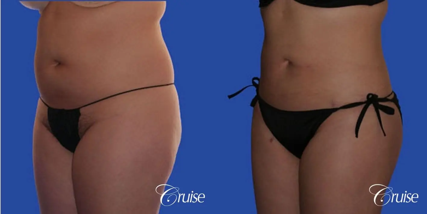 best pictures of liposuction with plastic surgeon in Newport Beach - Before and After 2