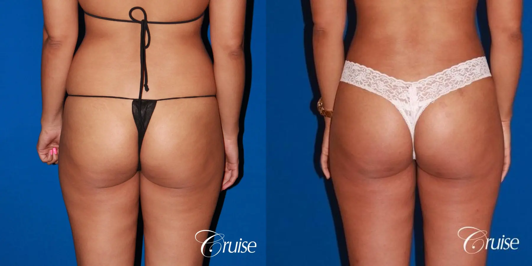 Liposuction Before & After Gallery: Patient 61