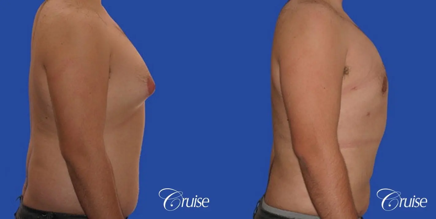 male liposuction abdomen flanks with Gynecomastia - Before and After 5