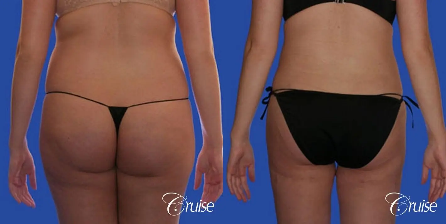 best pictures of liposuction with plastic surgeon in Newport Beach - Before and After 1