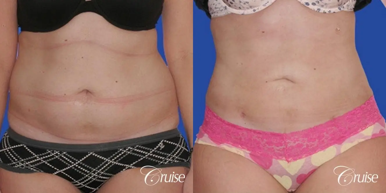Liposuction: Patient 27 - Before and After 1