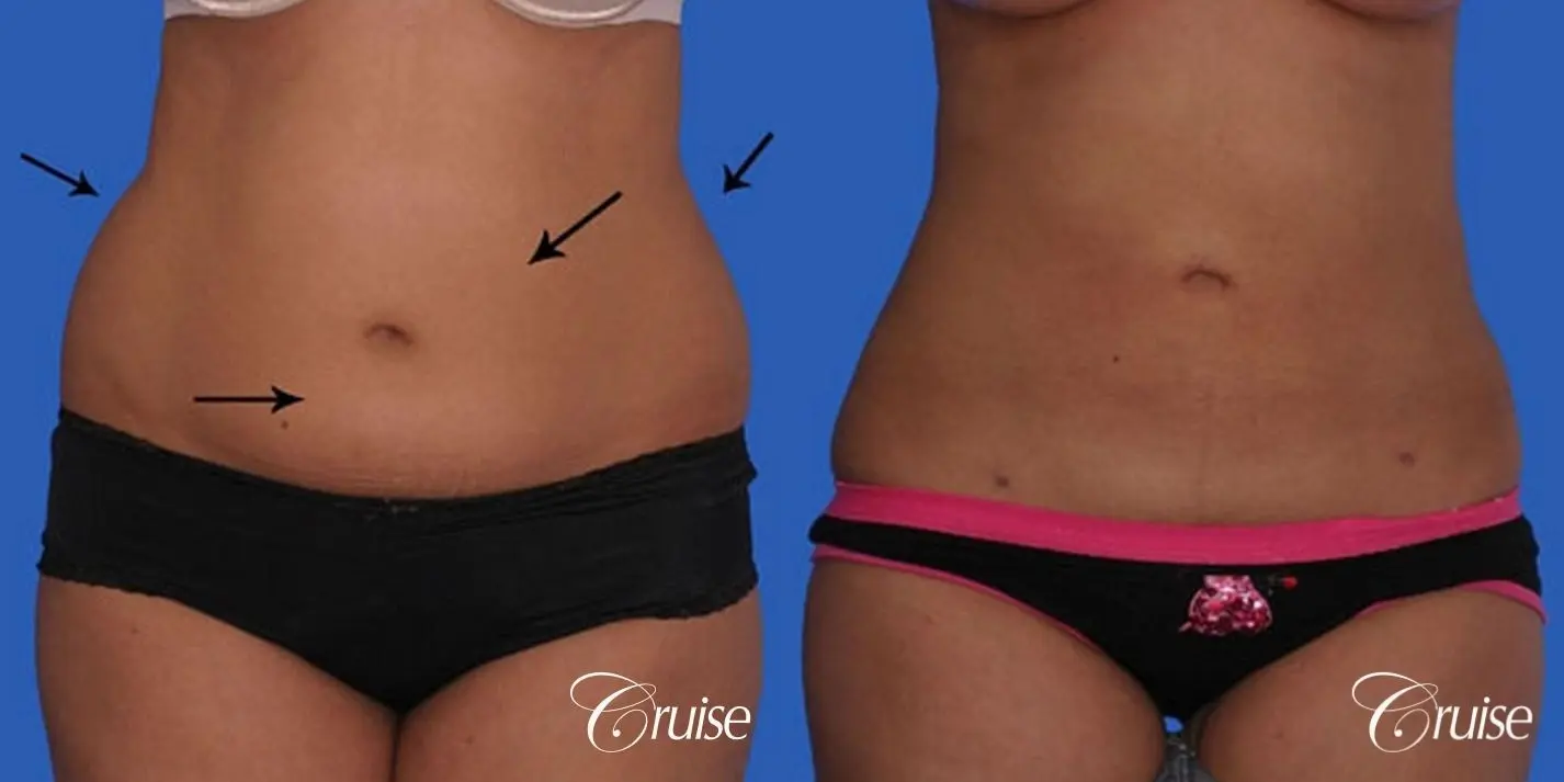 small waist with liposuction abdomen and flanks - Before and After 1
