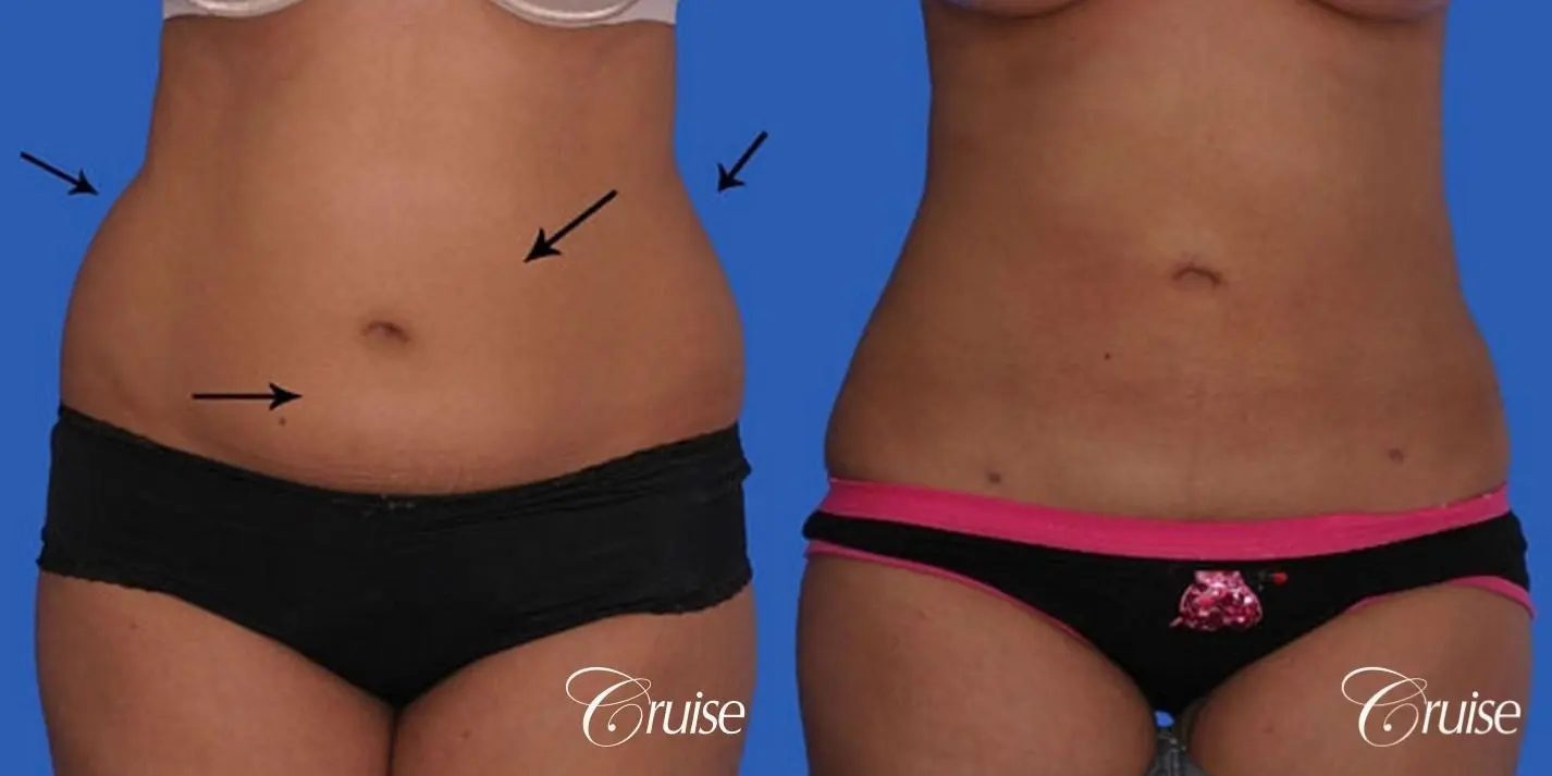 How Can I Remove Fat from My Flanks?, Liposuction Newport Beach