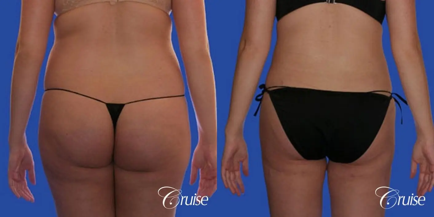best full body liposuction abdomen flanks thighs knees - Before and After 4