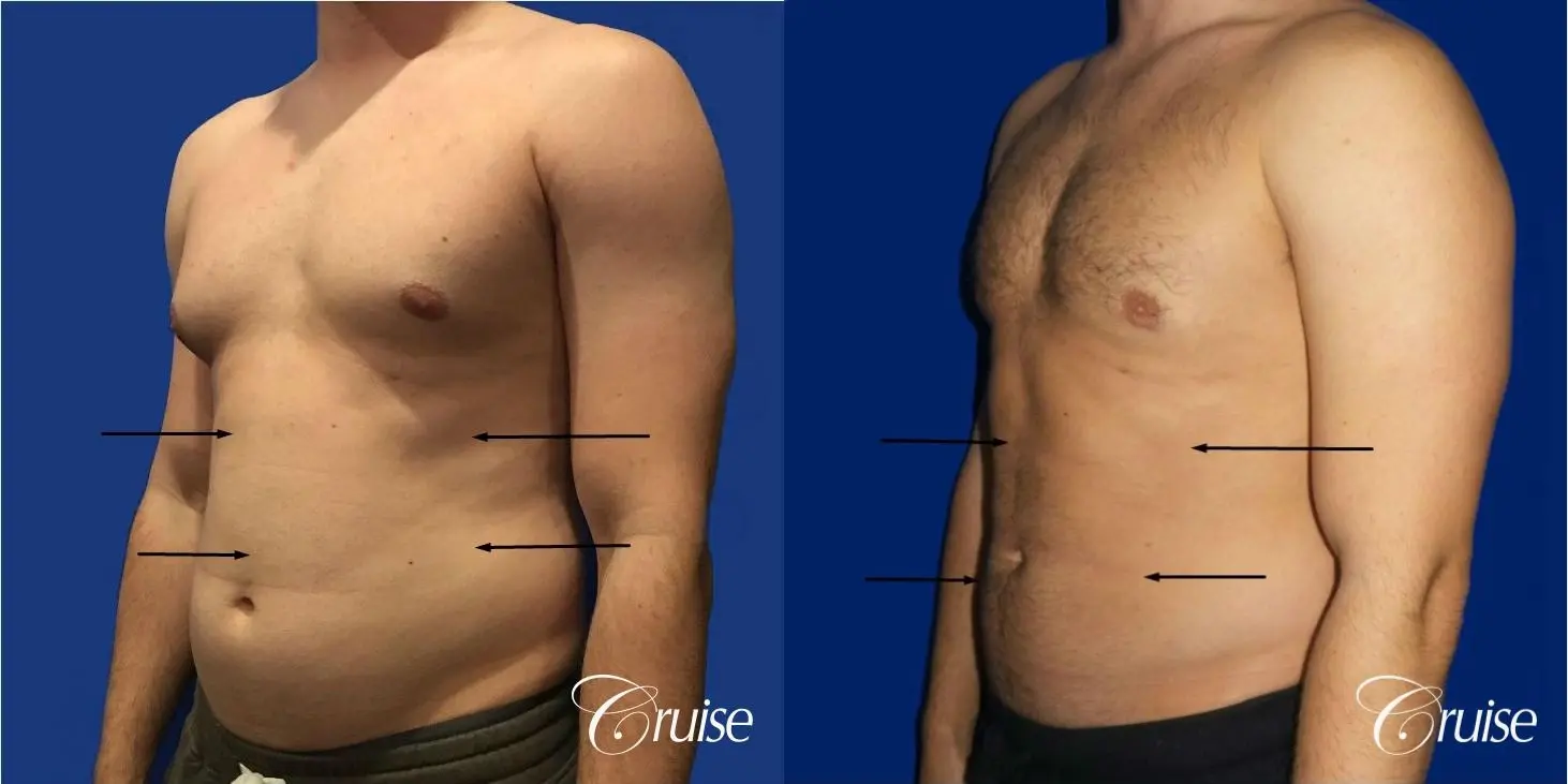 Liposuction Abdomen - Before and After 2
