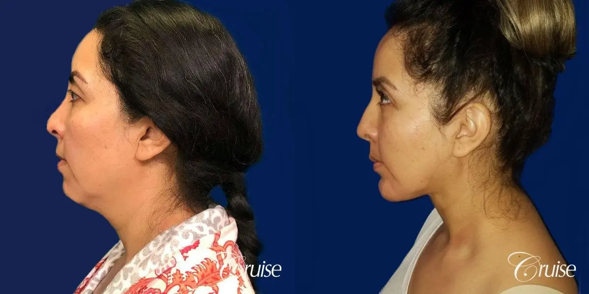 Liposuction of Neck/Jawline - Before and After 2
