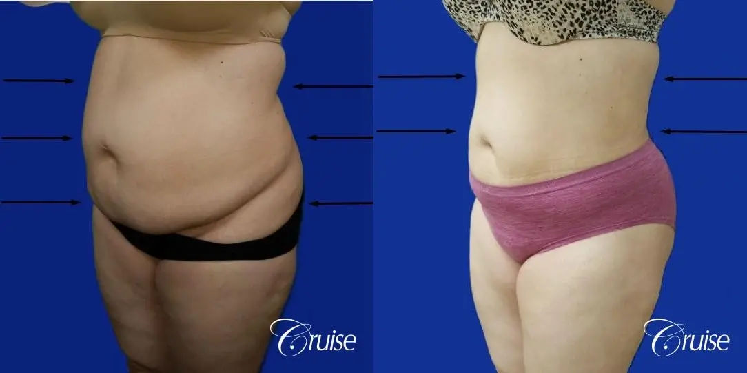 Best liposuction procedures dr cruise - Before and After 3