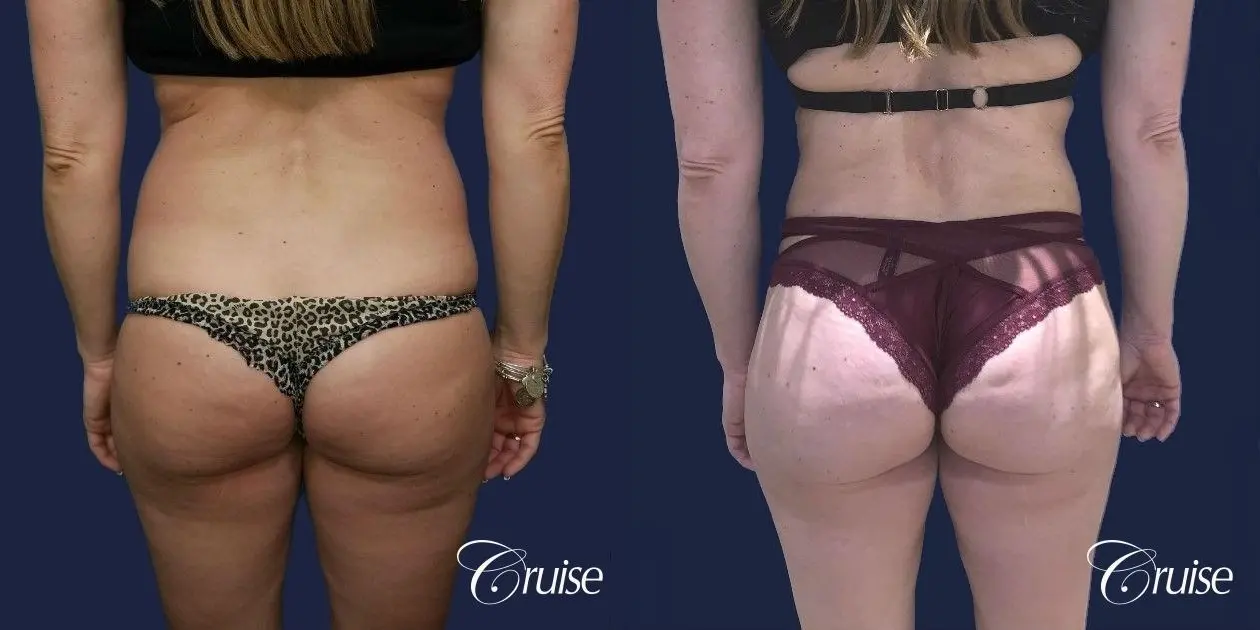 Liposuction - Before and After  