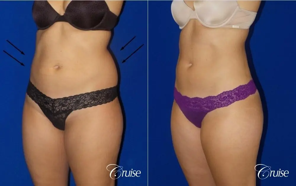Liposuction -  Flanks - Before and After 2
