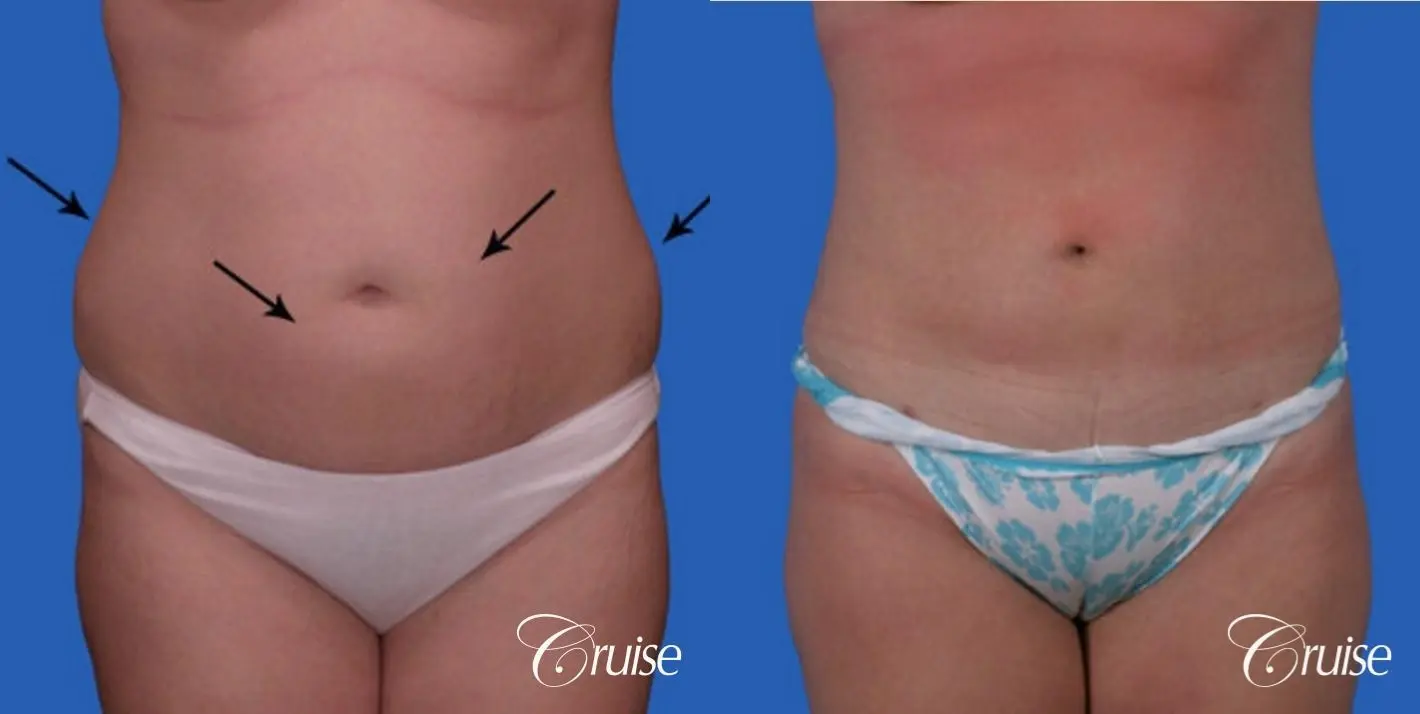liposuction on abdomen photos - Before and After 1