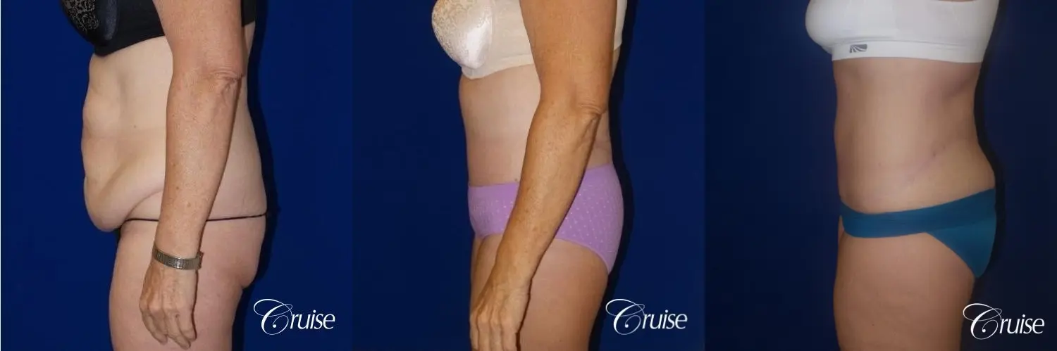 Liposuction with Circumferential Tummy Tuck w/BBL & Liposuction - Before and After 5
