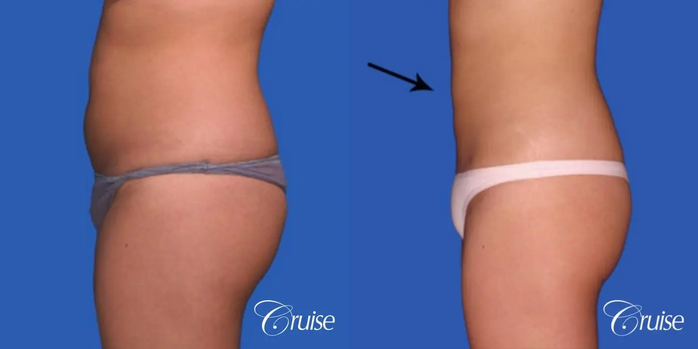 best before and after liposuction stomach and love handles - Before and After 2