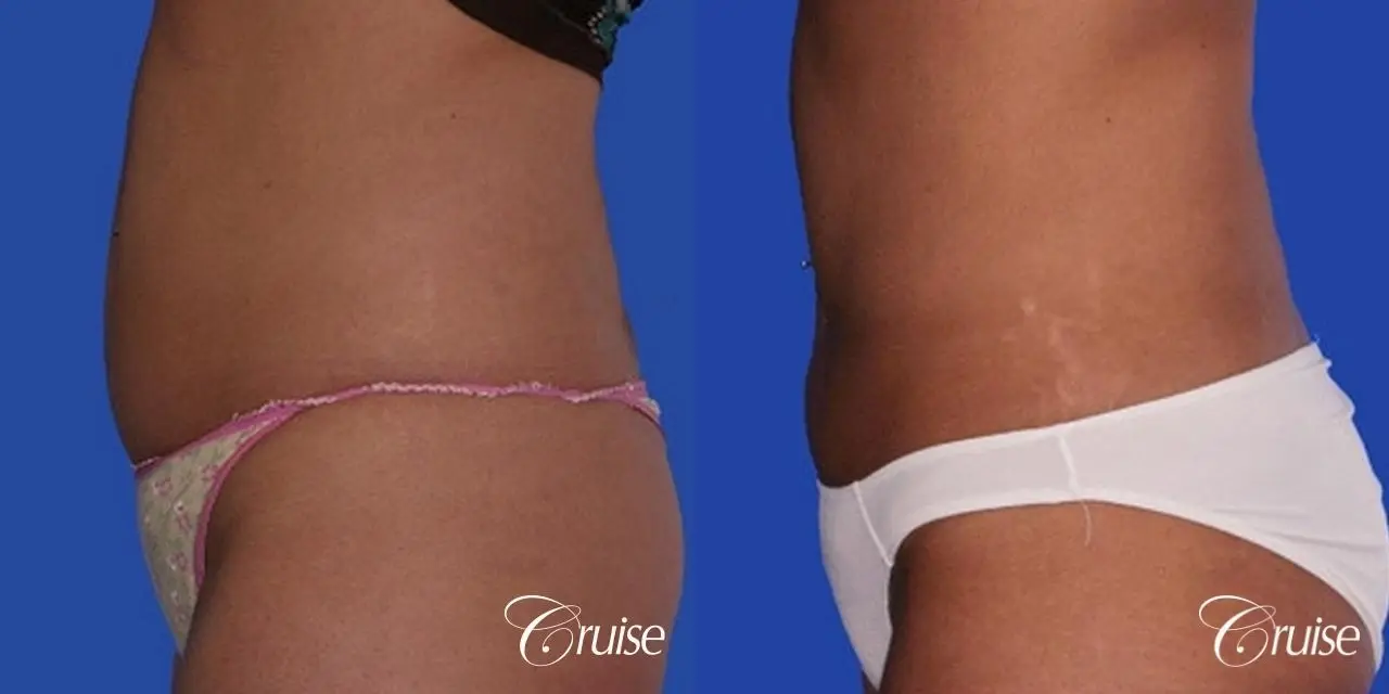 Liposculpture - Muffin Top Surgery Before and After Photos