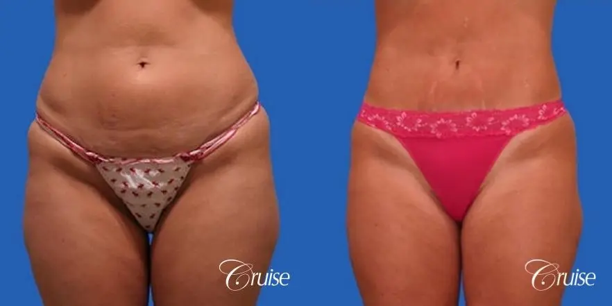 before and after pictures of liposuction abdomen and flanks - Before and After 1
