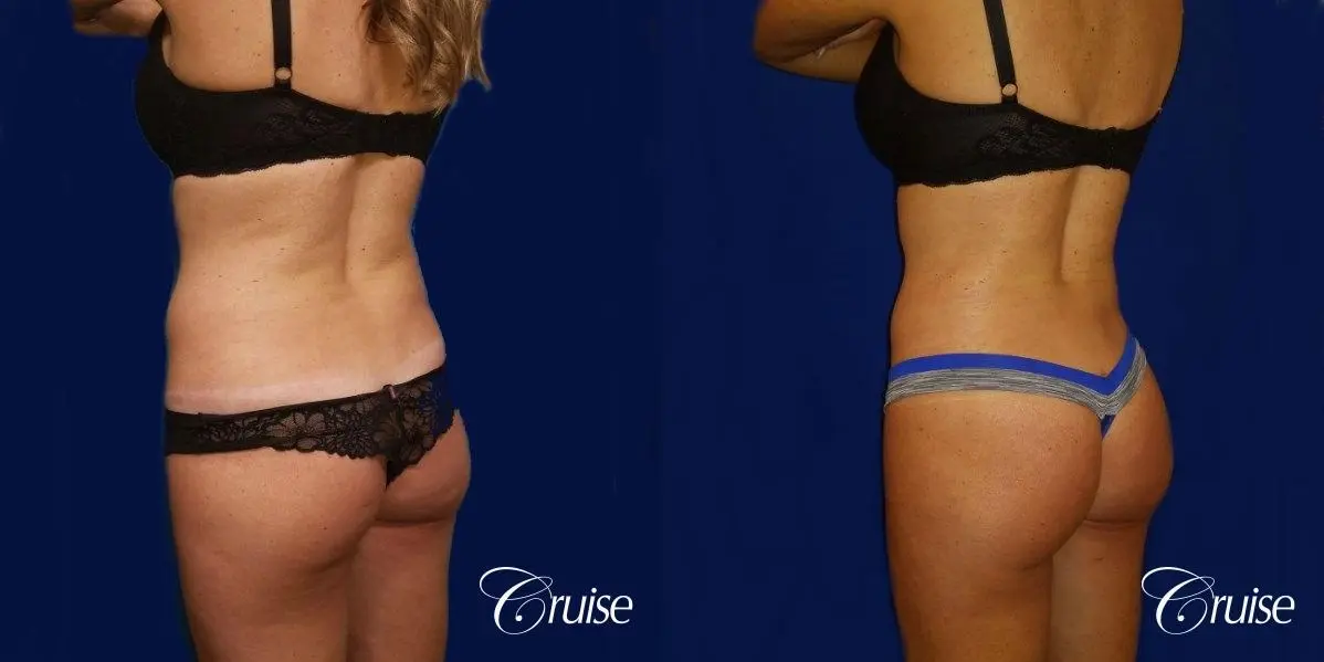 Brazilian Butt Lift Dr. Cruise - Before and After 3