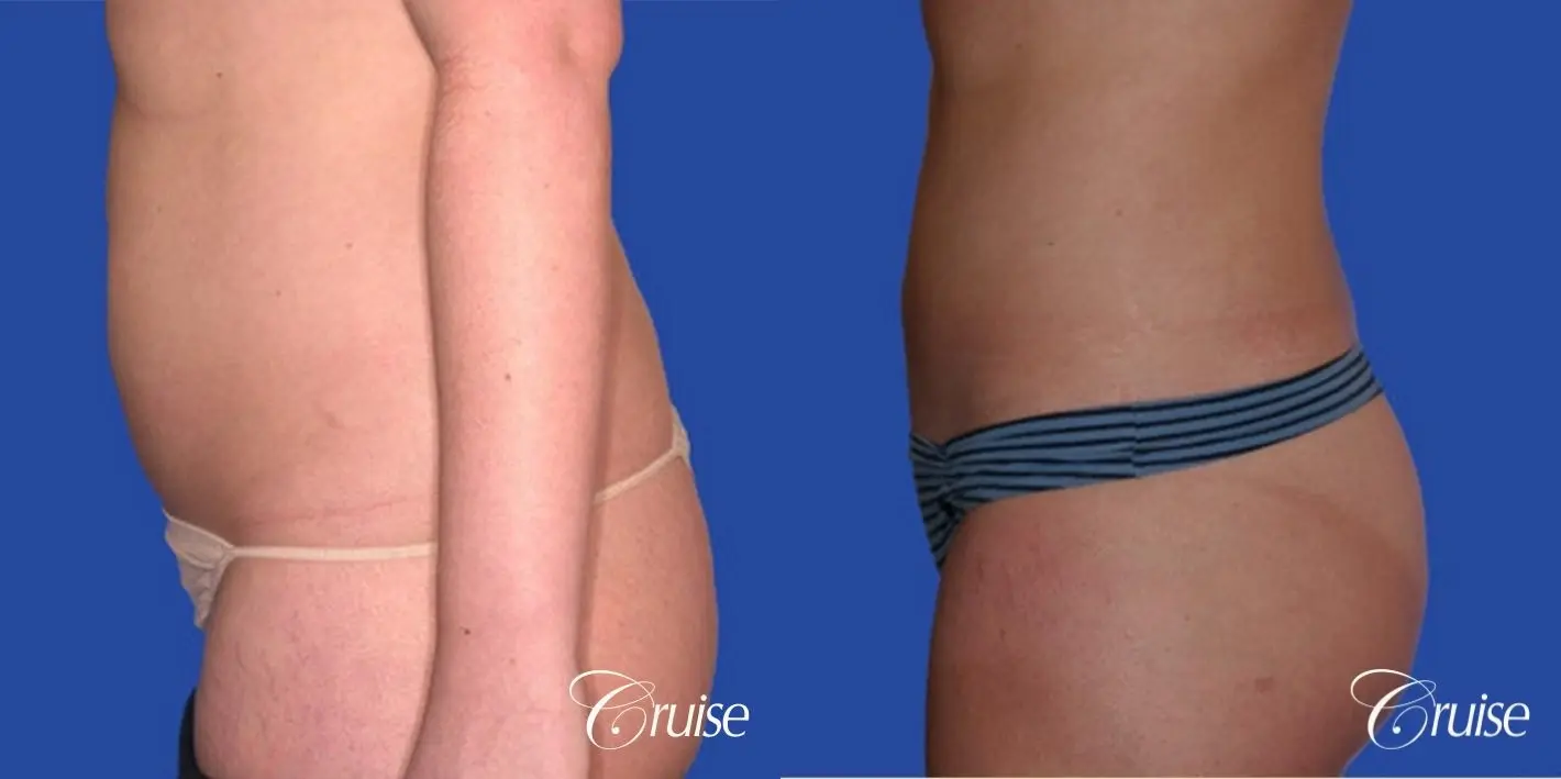 best skinny abs from liposuction abdomen and flanks - Before and After 3