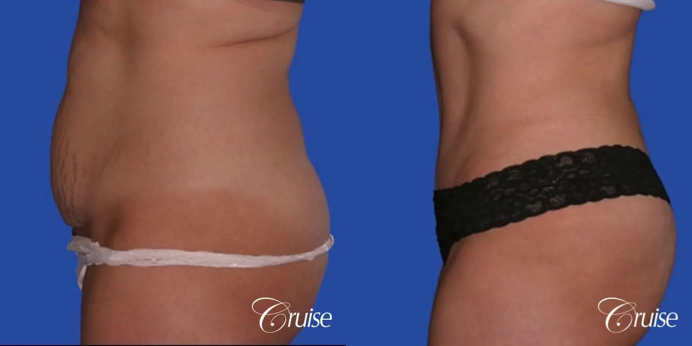 best dramatic flank liposuction pictures - Before and After 2