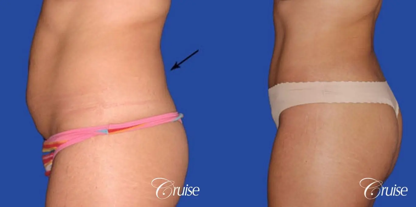 dramatic liposuction plastic surgeon does the best abdomen and flanks - Before and After 2