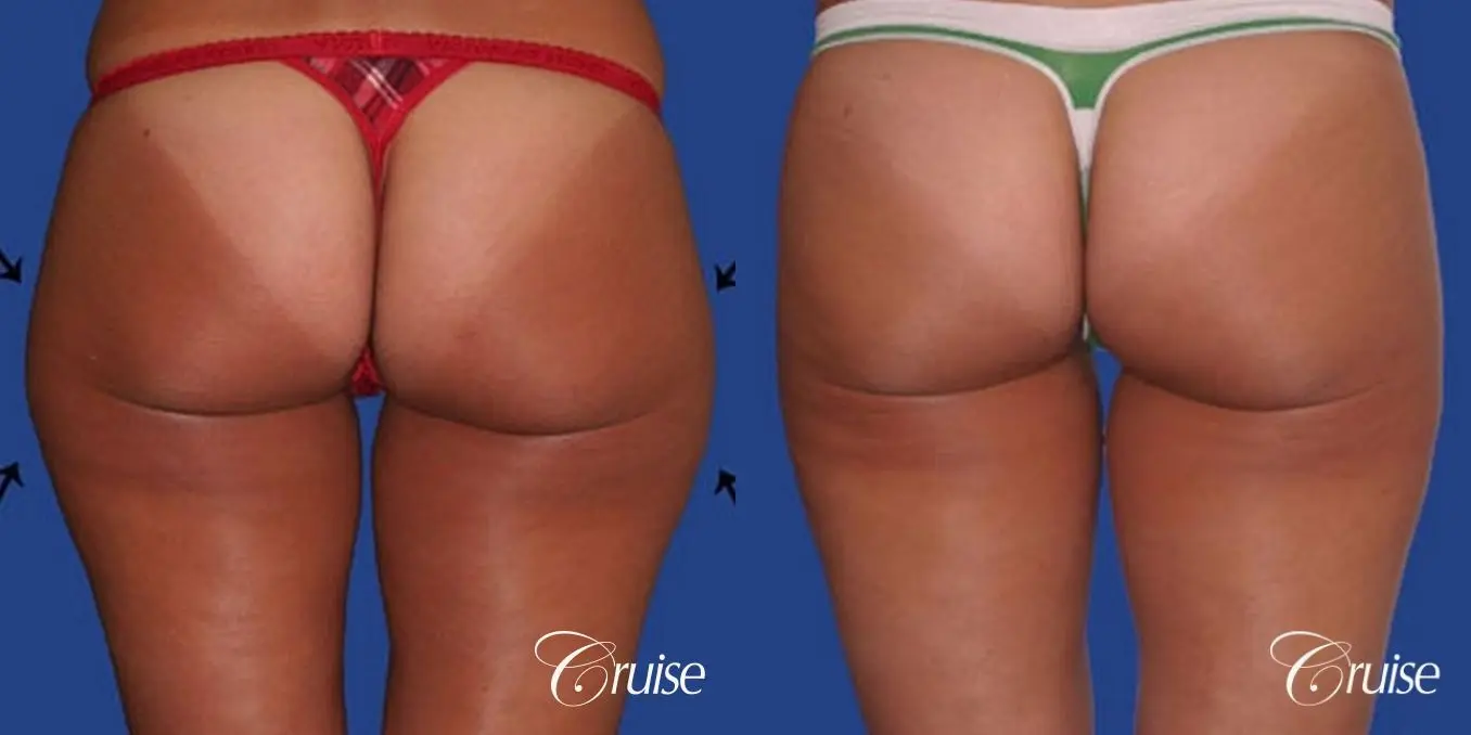 best thigh thinning liposuction on thighs - Before and After 1