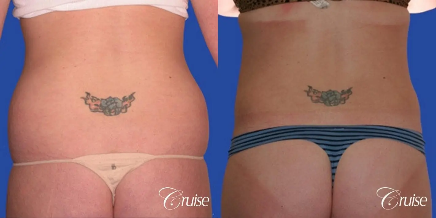 best skinny abs from liposuction abdomen and flanks - Before and After 2