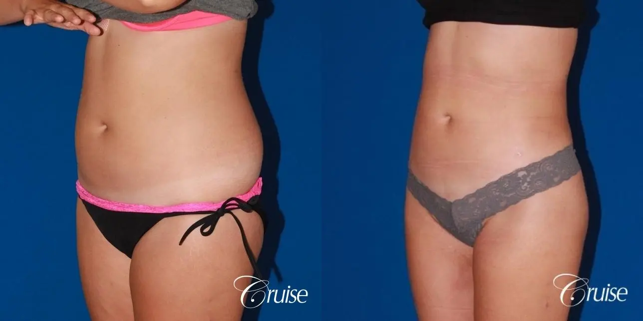 liposuction love handles and tummy - Before and After 2