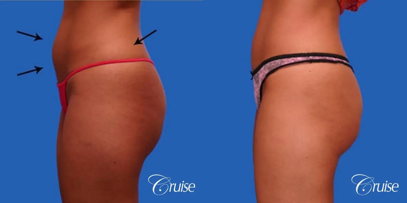 best tummy tuck with liposuction thighs - Before and After 2