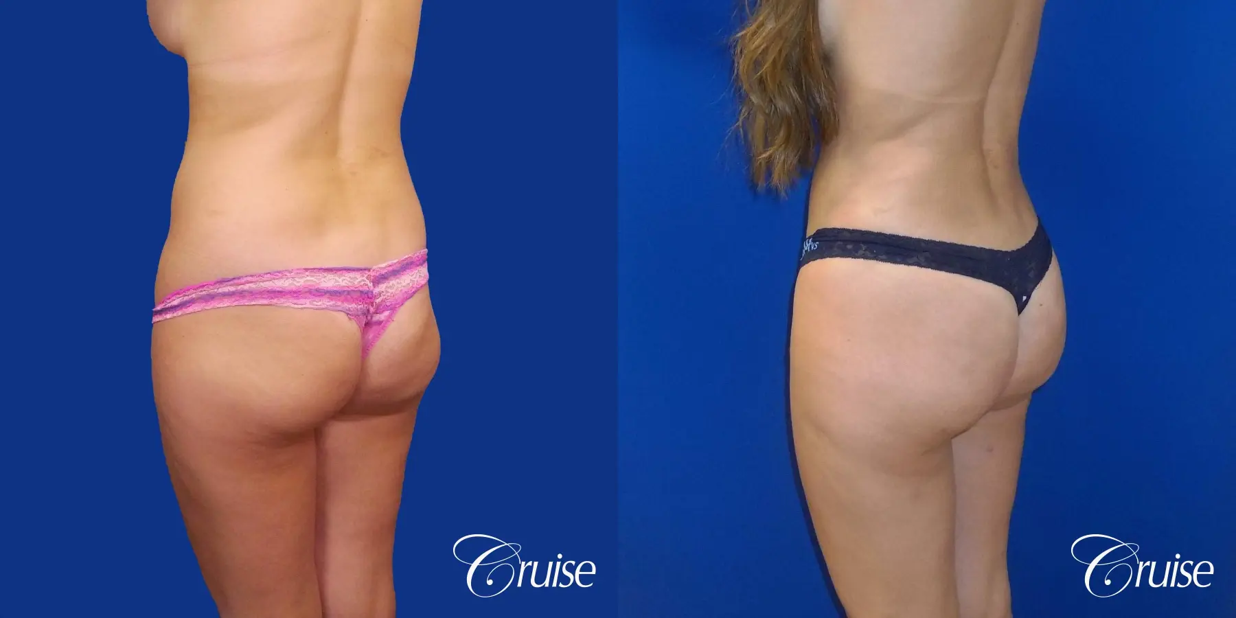 Liposuction - Before and After 3