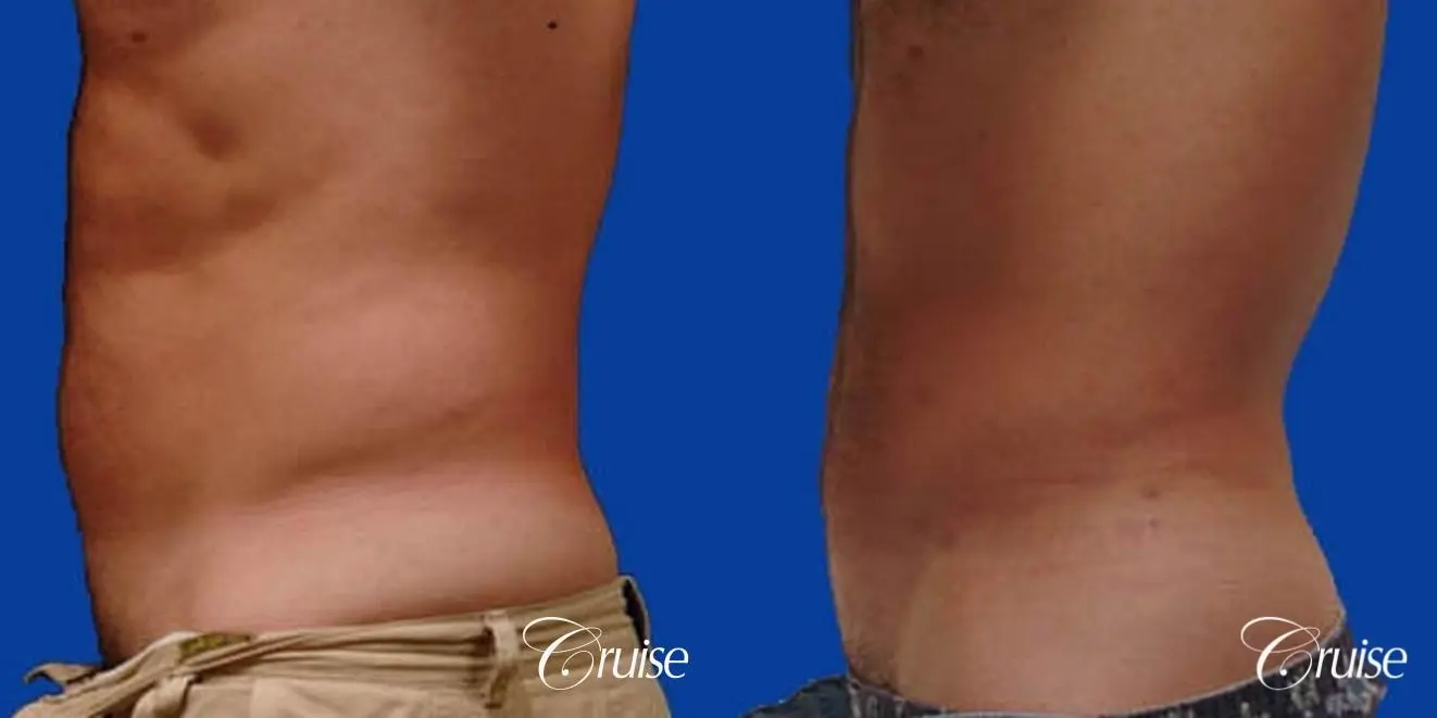 best male ab sculpting liposuction abdomen flanks - Before and After 2
