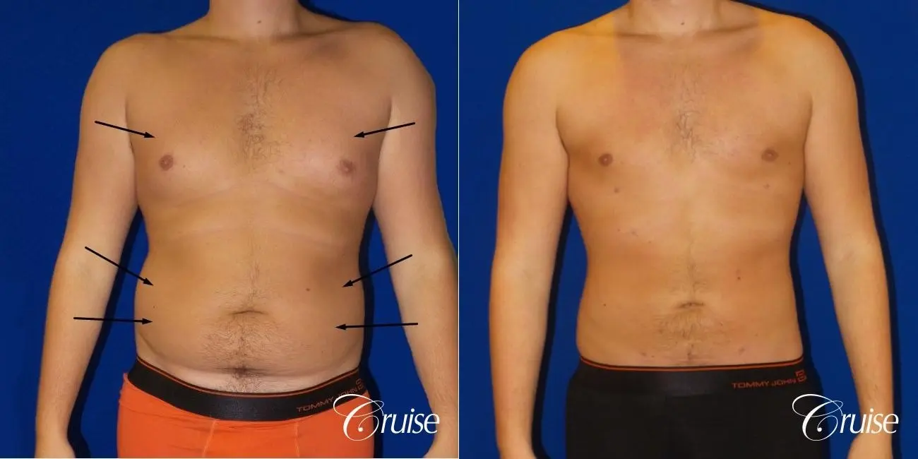 Best  before and after lipo photos of guys - Before and After