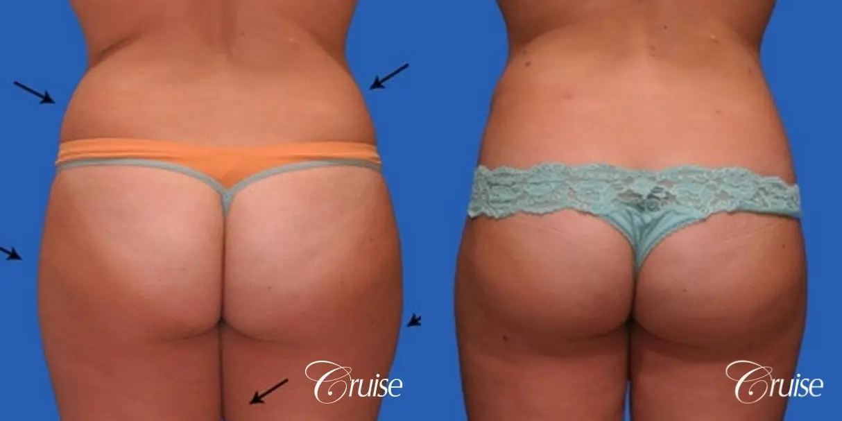best liposuction results on abdomen, flanks, thighs - Before and After 2