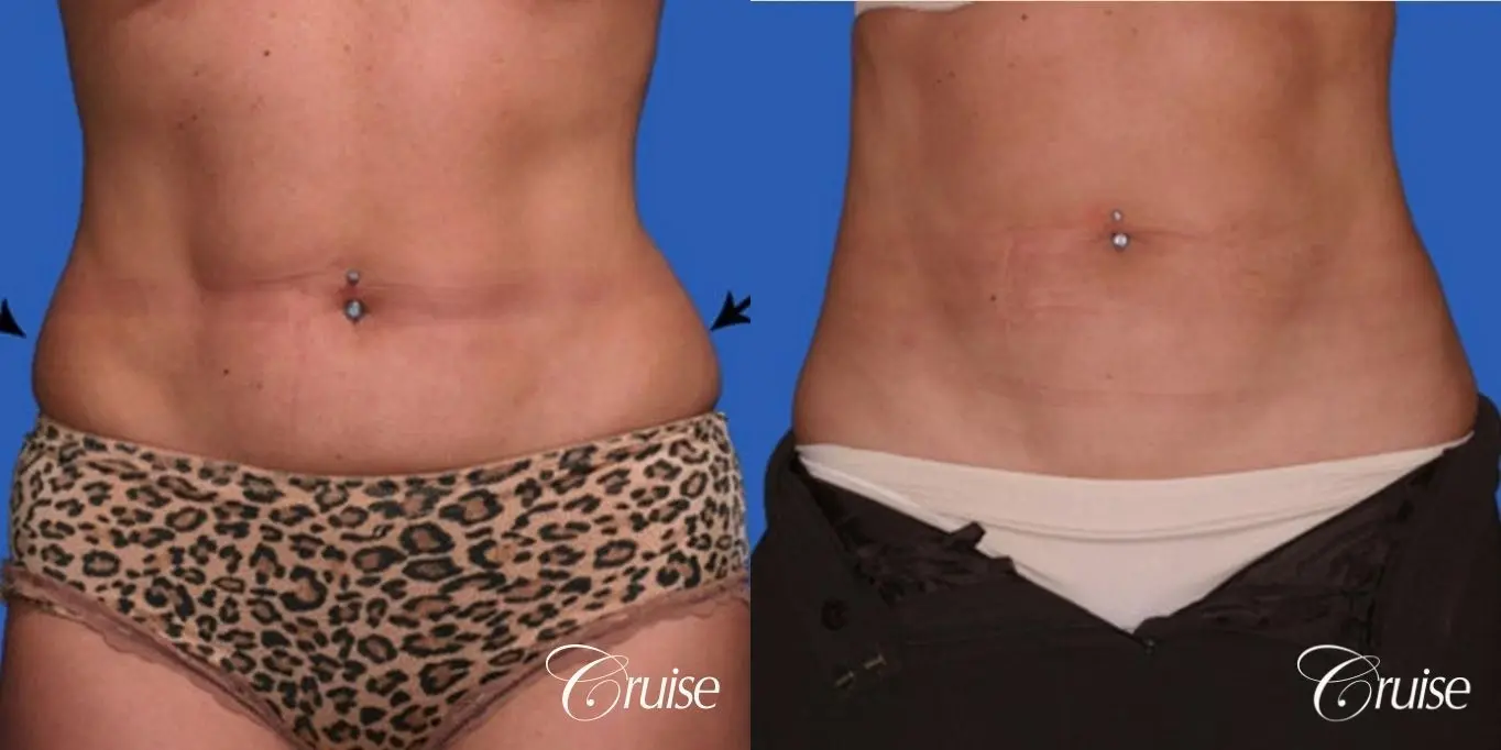 best lipo photos of love handles and stomach - Before and After 1