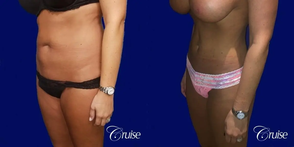 Liposuction Abdomen and Flanks with Midline Contour - Before and After 3