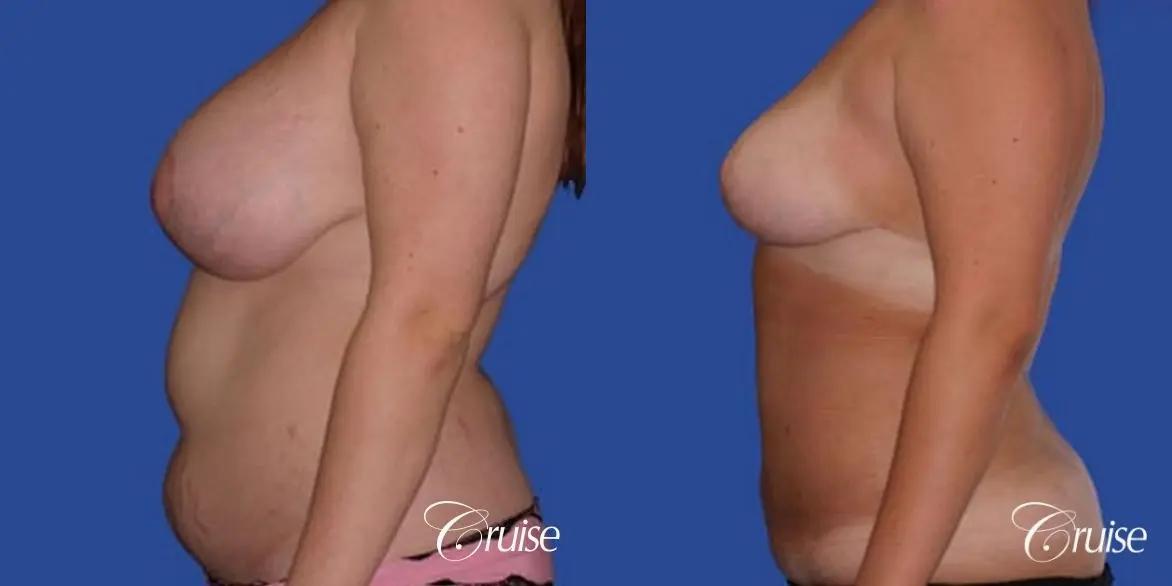 best before and after of liposuction abdomen, flanks, and upper back - Before and After 2