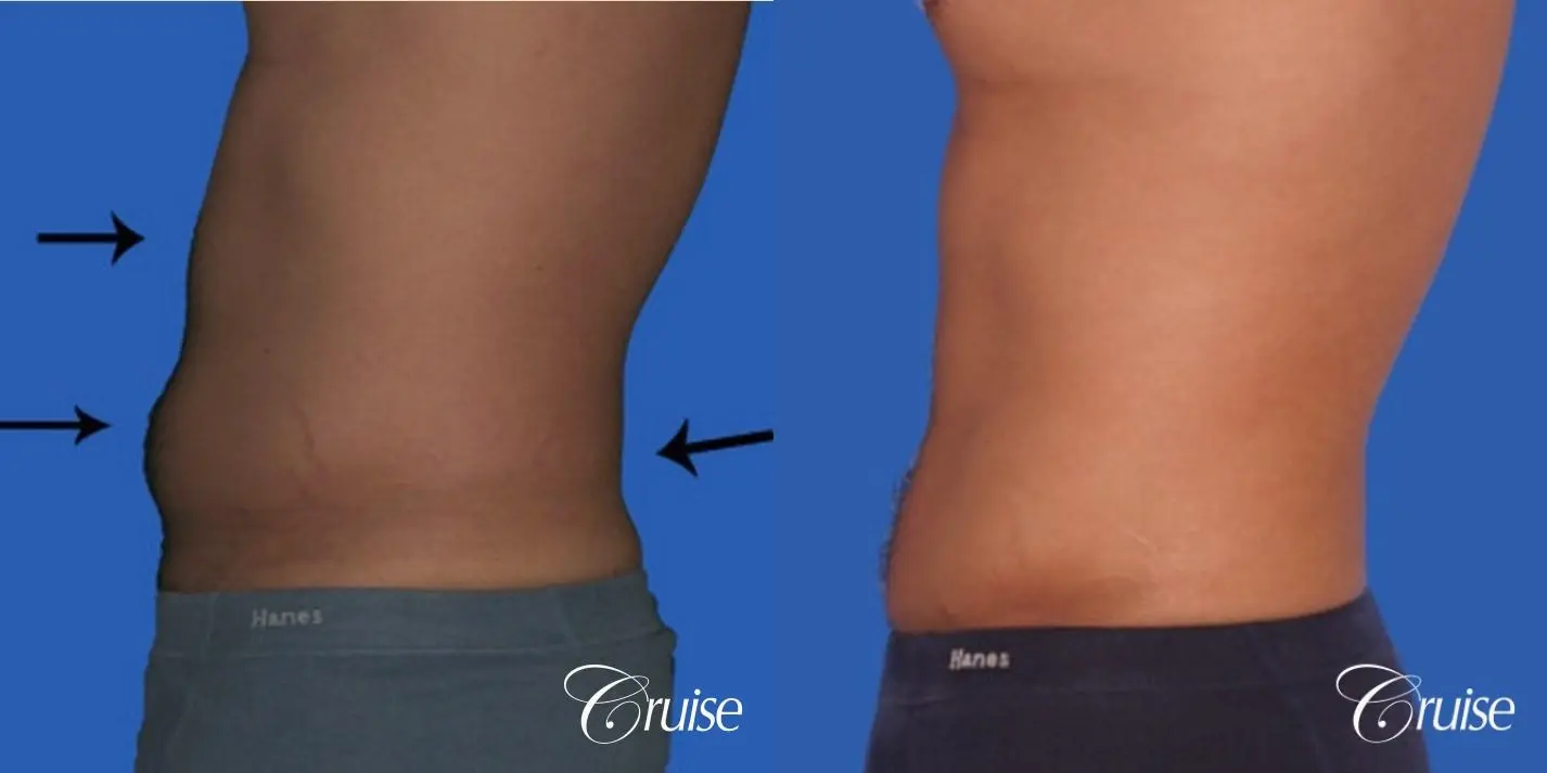best liposuction to contour a males body - Before and After 2