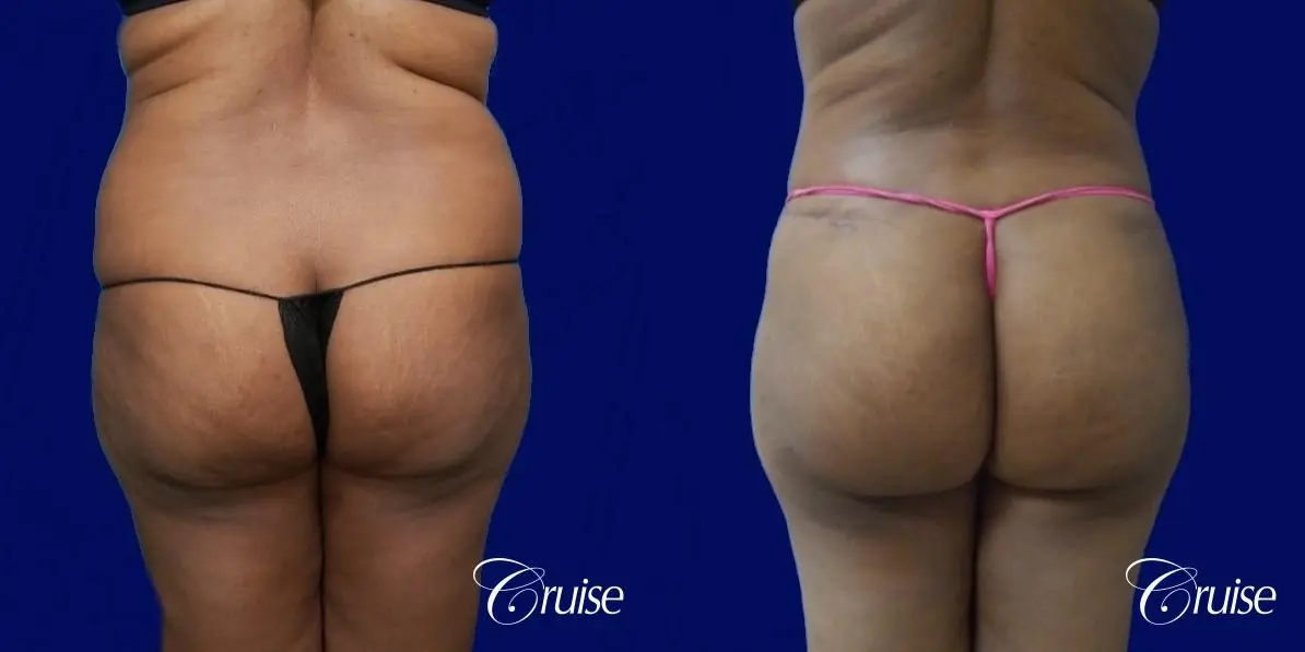 Liposuction Flanks - Before and After 4