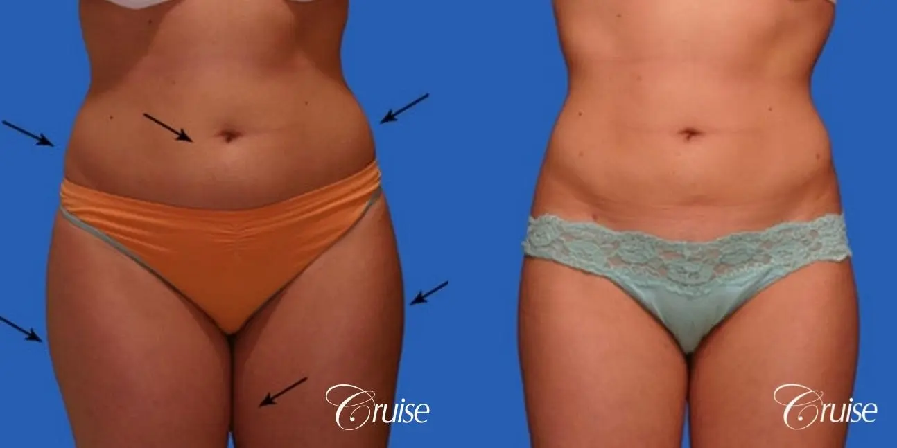 best liposuction results on abdomen, flanks, thighs - Before and After 1